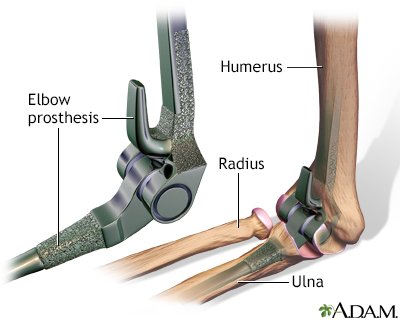 Knee Arthiritis
